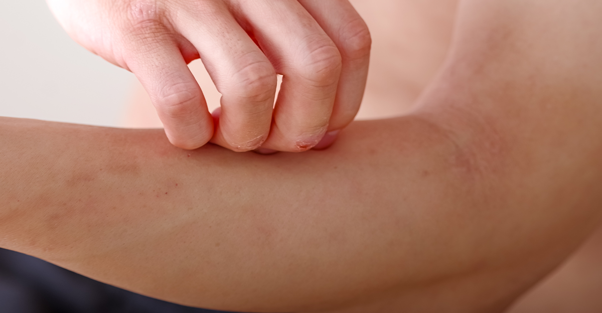 How to Get Rid of Eczema Scars