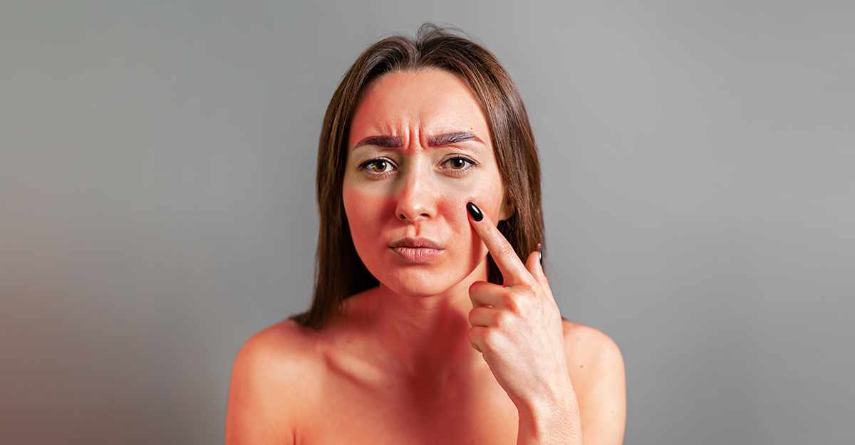 Too Much Sun: How to Heal Skin After a Sunburn